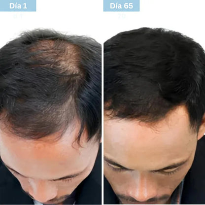 Daynava™ Roll-On para el Crecimiento del Cabello